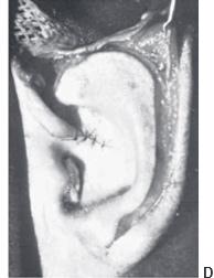 Cartilage grafts 4
