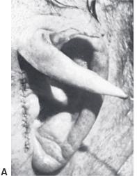 Cartilage grafts 1