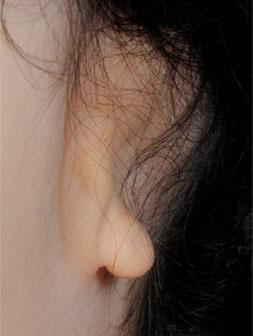 absent ear canal