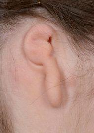 lobular microtia
