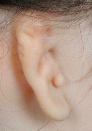 lobular microtia
