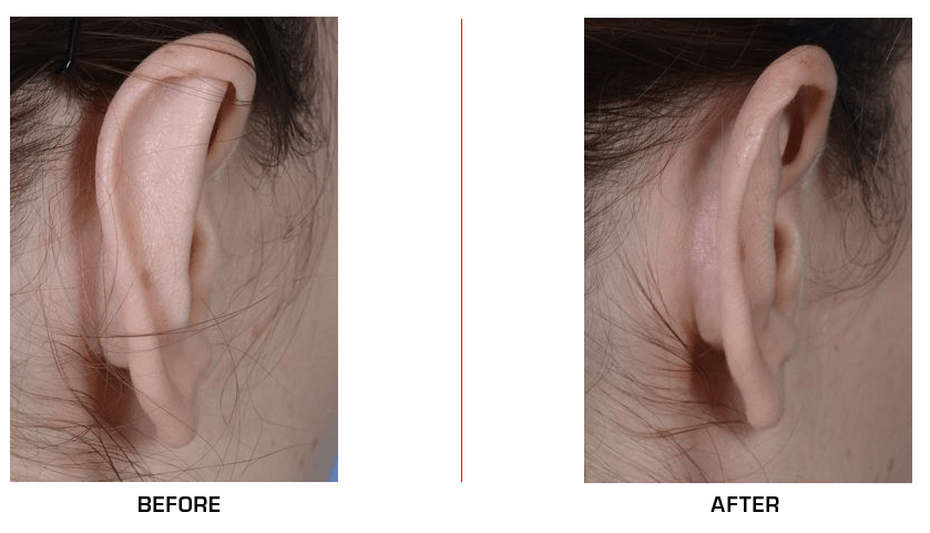 otoplasty before after case2