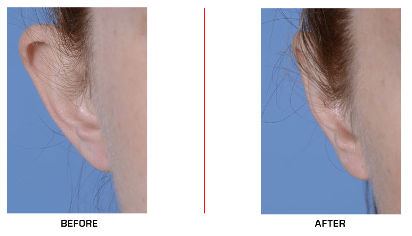 otoplasty before after case5